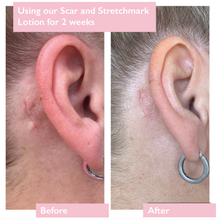 Load image into Gallery viewer, Before-and-after pictures of a woman&#39;s face side-on, showing a scar behind her ear, with it looking less prominent in the after picture. Vegan and cruelty-free. Available at Lovethical along with plenty of other vegan and cruelty-free beauty products, makeup, make up, toiletries and cosmetics for all your gift and present needs. 
