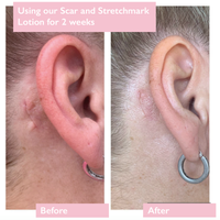 Before-and-after pictures of a woman's face side-on, showing a scar behind her ear, with it looking less prominent in the after picture. Vegan and cruelty-free. Available at Lovethical along with plenty of other vegan and cruelty-free beauty products, makeup, make up, toiletries and cosmetics for all your gift and present needs. 